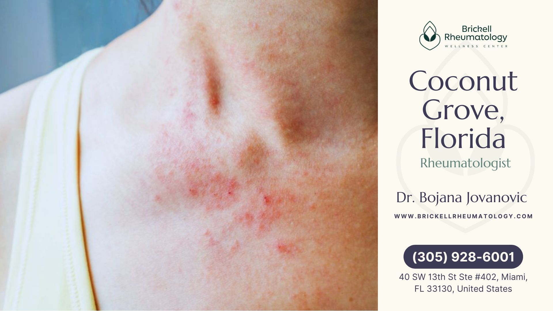 A close-up of a person's neck and upper chest showing a red, inflamed rash, which may be associated with lupus or other autoimmune skin conditions.