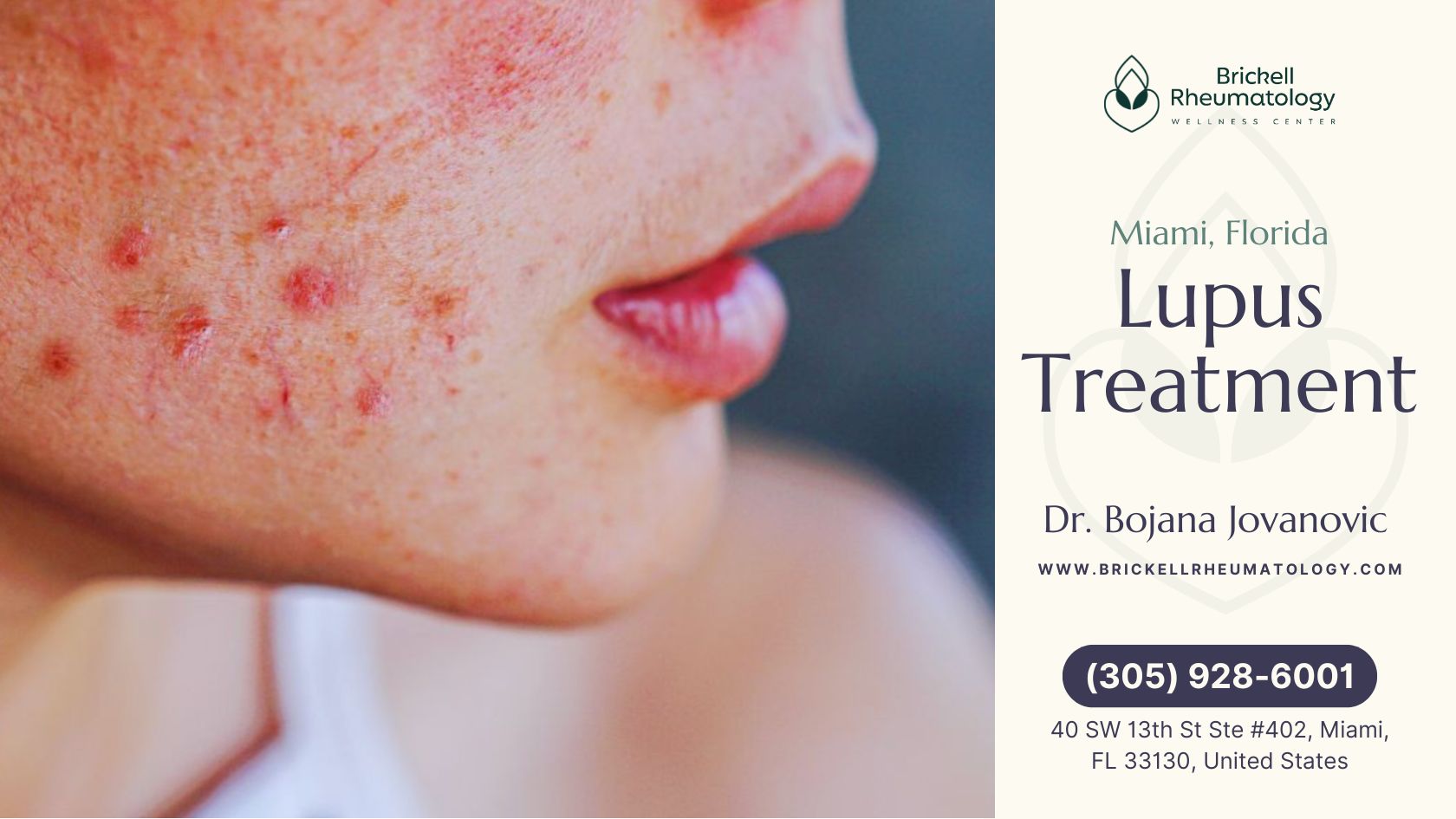 Lupus Treatment 1 Close-up of a person's lower face with red, inflamed skin, acne-like lesions, and a rash, which may be associated with lupus.