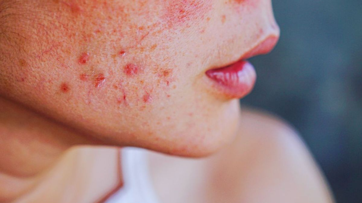 Close-up of a person's lower face with red, inflamed skin, and a rash, which may be associated with lupus.