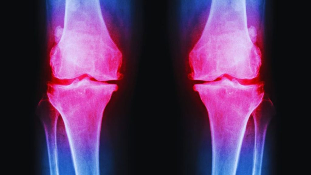 X-ray of both knees showing osteoarthritis-related joint space narrowing, bone changes, and inflammation.