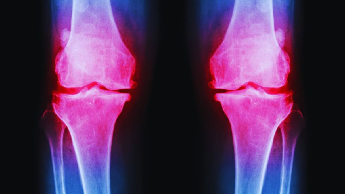 Osteoarthritis Management: How Can Physical Therapy Help? 1 X-ray of both knees showing osteoarthritis-related joint space narrowing, bone changes, and inflammation.