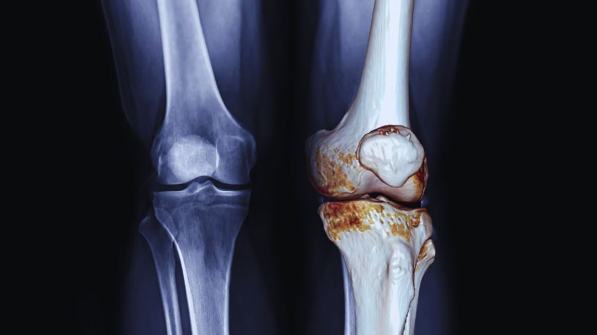 A medical image comparing healthy and osteoarthritic knee joints, showing an X-ray view on the left and a detailed illustration on the right with worn cartilage and bone changes typical of osteoarthritis. The right knee displays joint degeneration and inflammation.