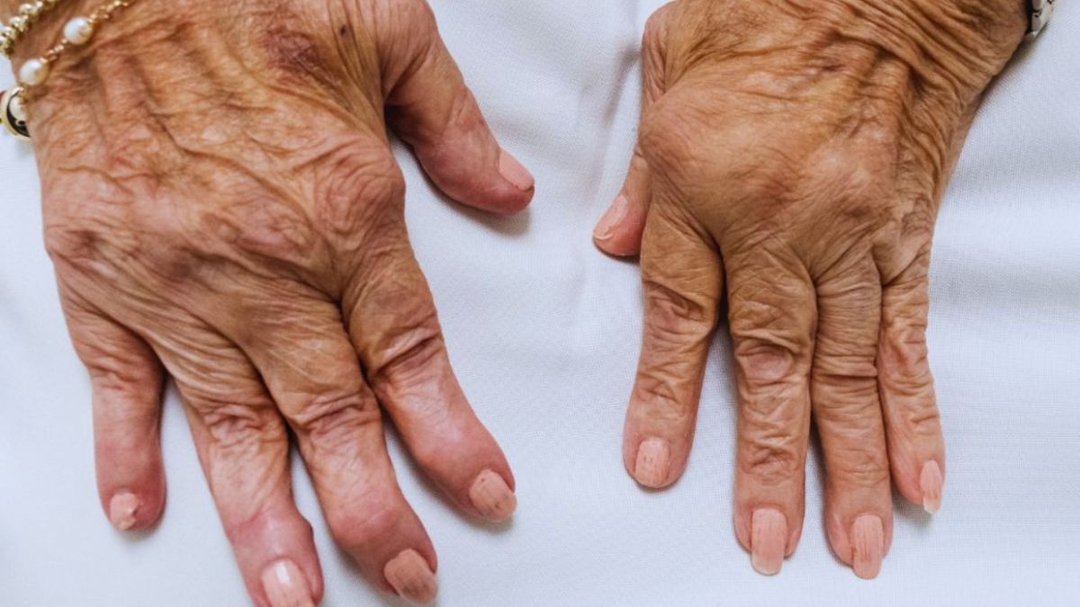 Close-up of an older woman's hands showing wrinkles and skin texture, indicating the effects of rheumatoid arthritis.