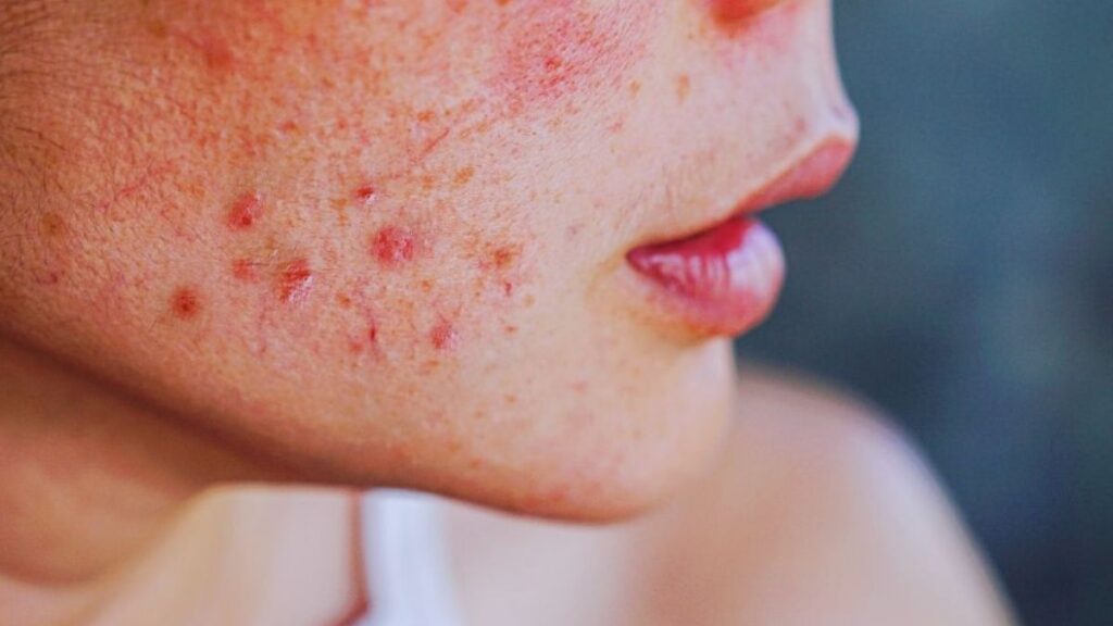 Close-up of a person’s face showing a red facial rash and skin irritation, a common skin symptom associated with lupus.