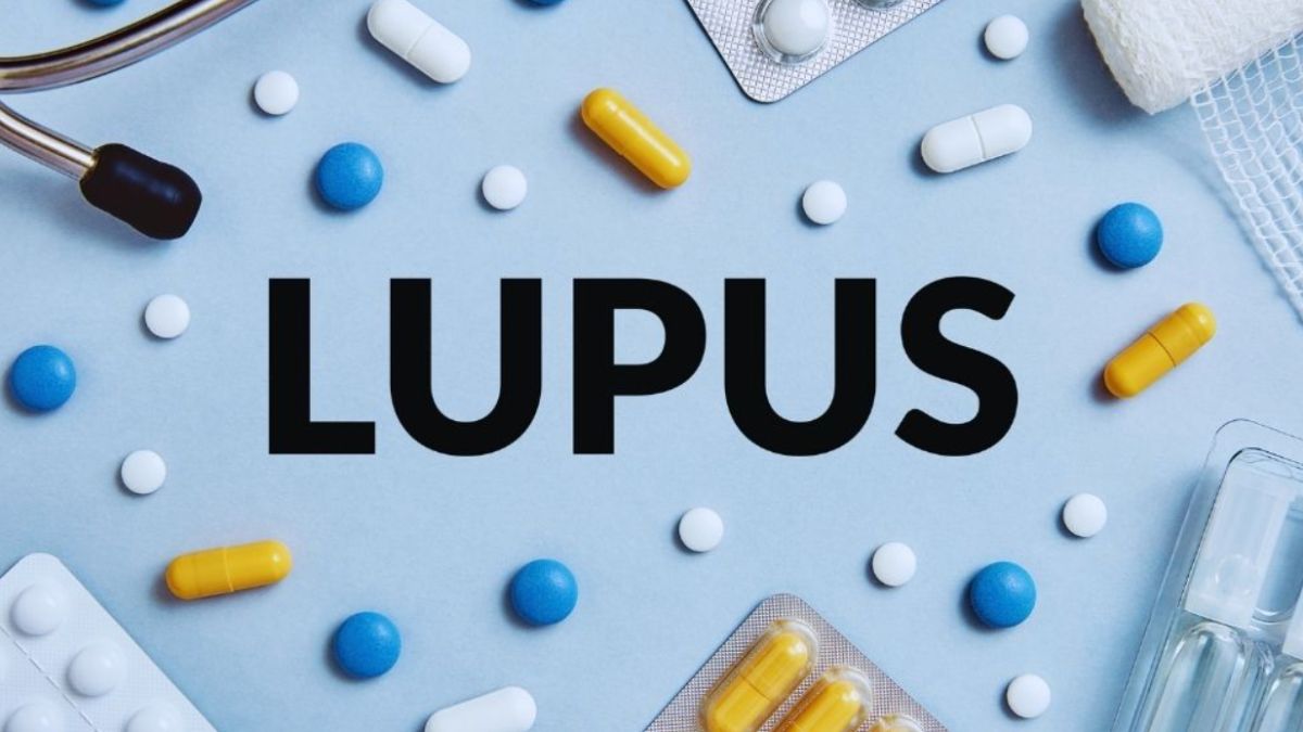 Lupus Treatment Brickell concept image showing the word “LUPUS” surrounded by prescription pills, capsules, and medical supplies, representing diagnosis, treatment options, and ongoing care for lupus management.